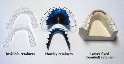 how much does it cost to replace a plastic retainer – Delving into the Economics and Practicality of Orthodontic Retainer Replacement